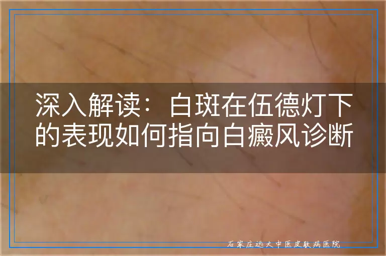 深入解读：白斑在伍德灯下的表现如何指向白癜风诊断