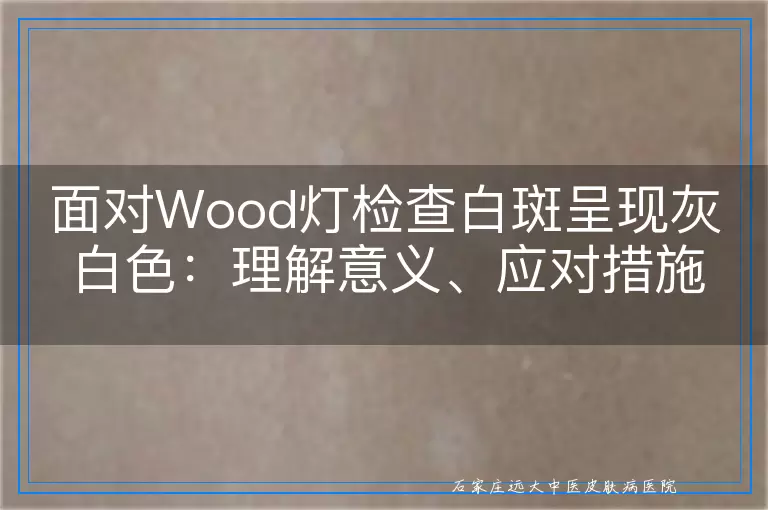 面对Wood灯检查白斑呈现灰白色：理解意义、应对措施与后续关注