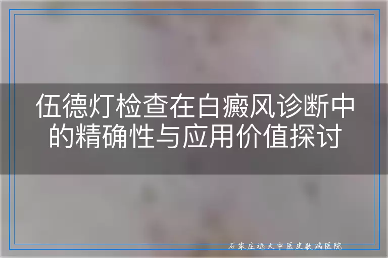 伍德灯检查在白癜风诊断中的精确性与应用价值探讨