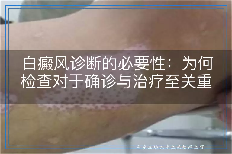 白癜风诊断的必要性：为何检查对于确诊与治疗至关重要