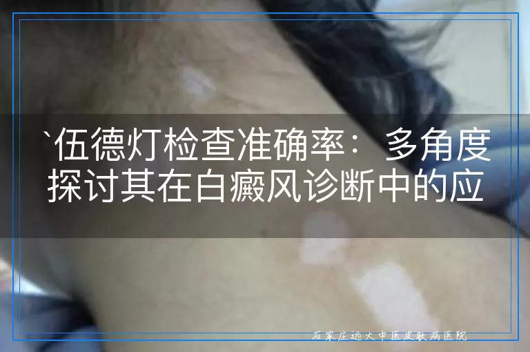 伍德灯检查准确率：多角度探讨其在白癜风诊断中的应用效果