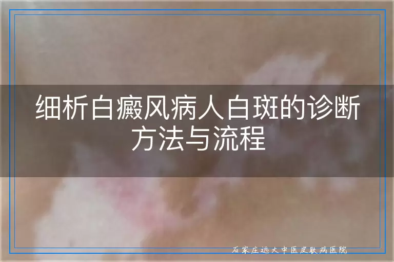细析白癜风病人白斑的诊断方法与流程