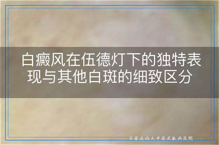 白癜风在伍德灯下的独特表现与其他白斑的细致区分