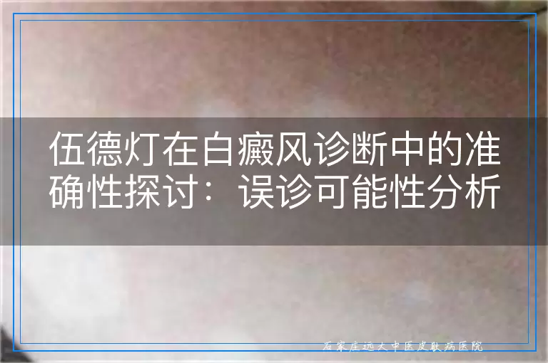 伍德灯在白癜风诊断中的准确性探讨：误诊可能性分析