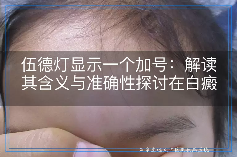 伍德灯显示一个加号：解读其含义与准确性探讨在白癜风诊断中的应用