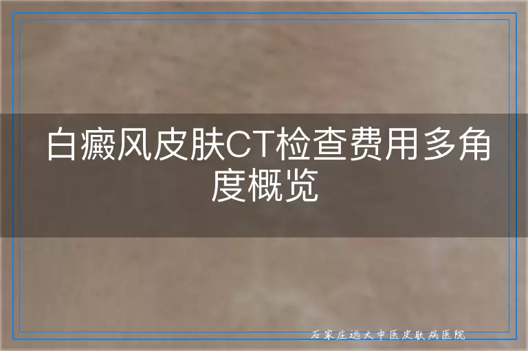 白癜风皮肤CT检查费用多角度概览