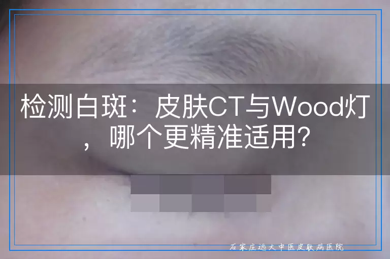 检测白斑：皮肤CT与Wood灯，哪个更精准适用？