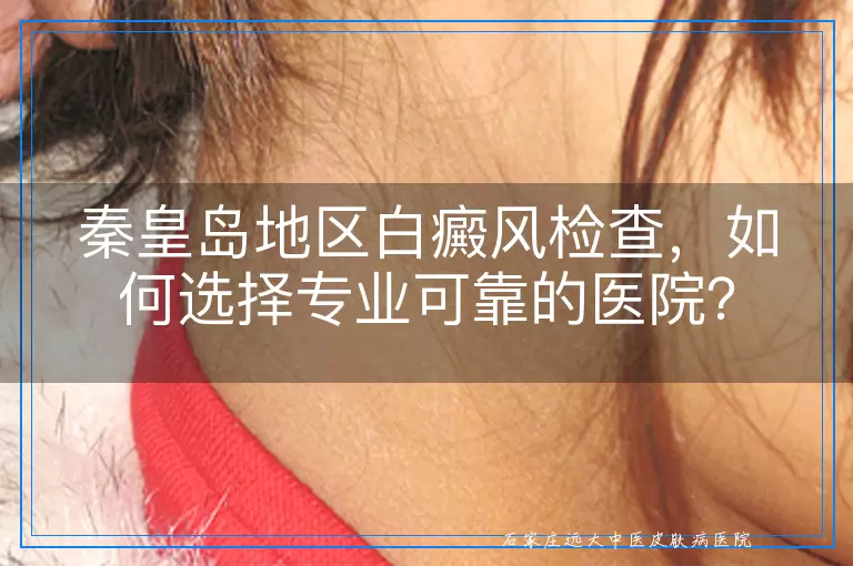 秦皇岛地区白癜风检查，如何选择专业可靠的医院？