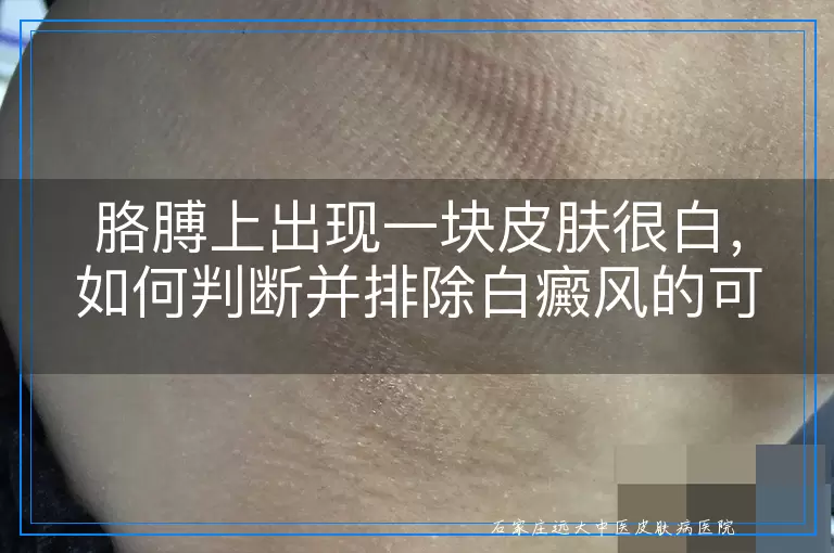 胳膊上出现一块皮肤很白，如何判断并排除白癜风的可能性？