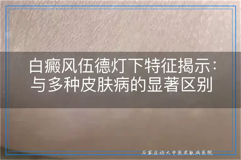 白癜风伍德灯下特征揭示：与多种皮肤病的显著区别