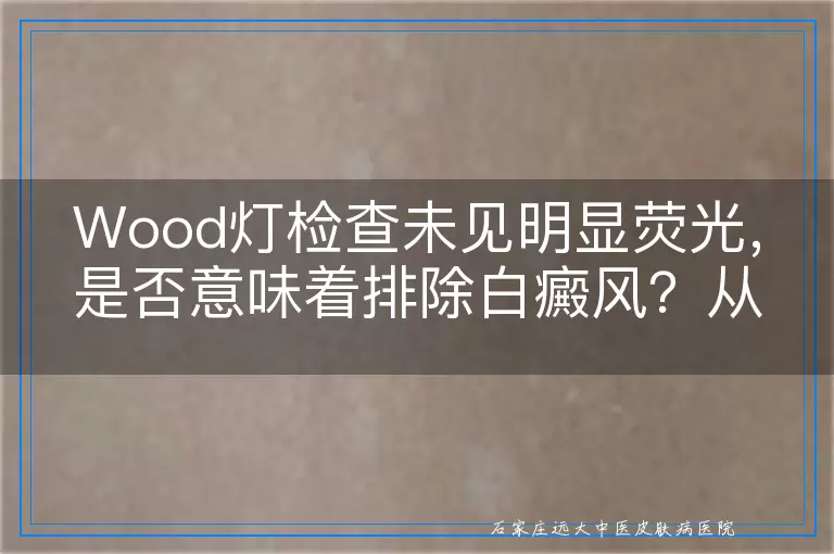 Wood灯检查未见明显荧光，是否意味着排除白癜风？从多角度深入探讨