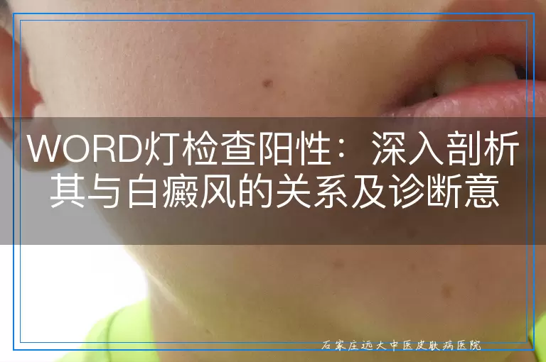 WORD灯检查阳性：深入剖析其与白癜风的关系及诊断意义