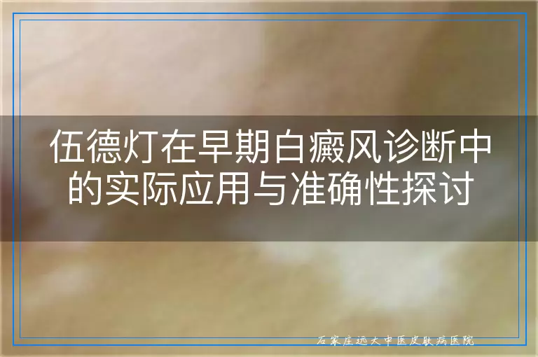 伍德灯在早期白癜风诊断中的实际应用与准确性探讨