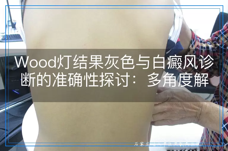 Wood灯结果灰色与白癜风诊断的准确性探讨：多角度解析