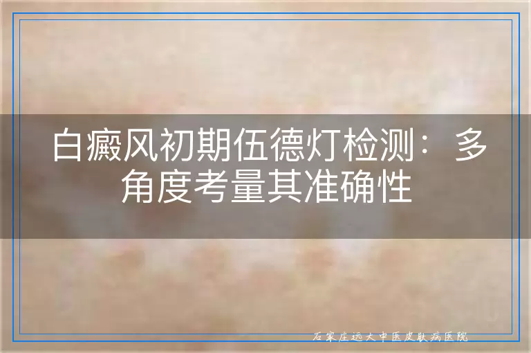 白癜风初期伍德灯检测：多角度考量其准确性
