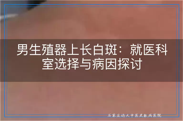 男生殖器上长白斑：就医科室选择与病因探讨