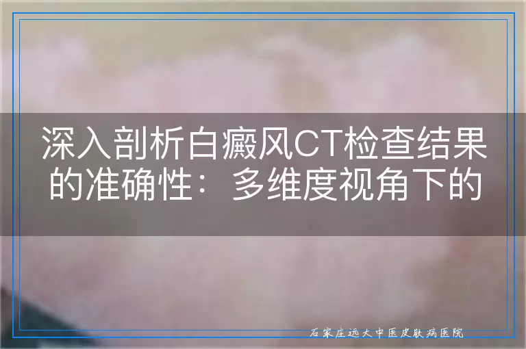 深入剖析白癜风CT检查结果的准确性：多维度视角下的真实反馈