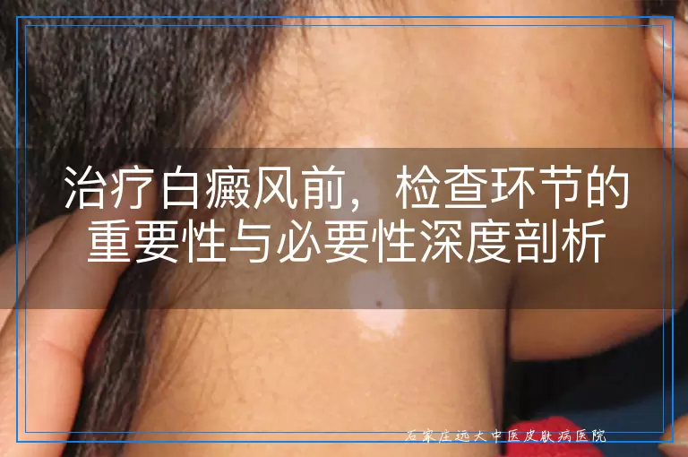 治疗白癜风前，检查环节的重要性与必要性深度剖析