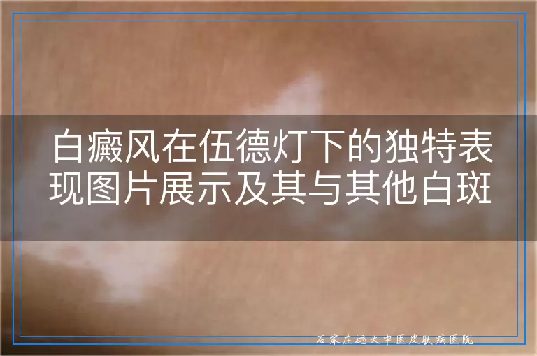 白癜风在伍德灯下的独特表现图片展示及其与其他白斑的细致区分