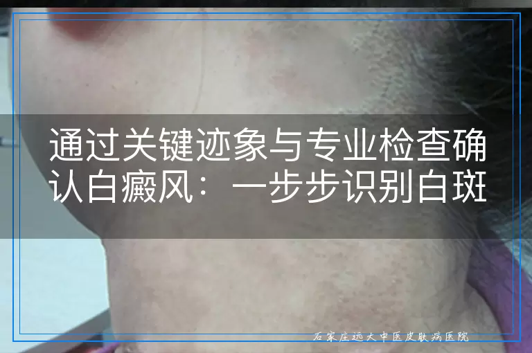 通过关键迹象与专业检查确认白癜风：一步步识别白斑的真相