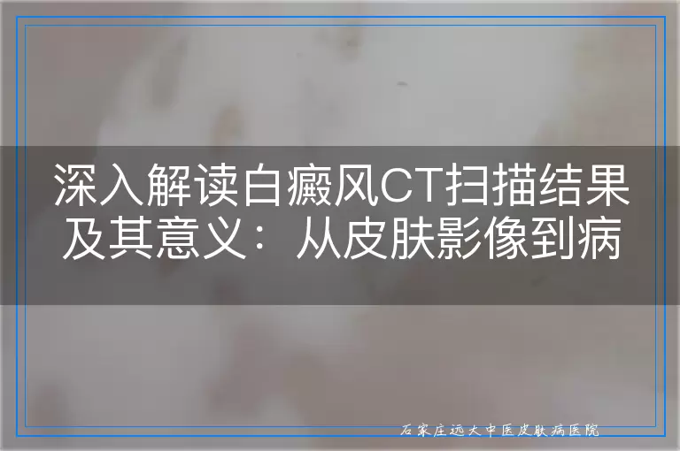 深入解读白癜风CT扫描结果及其意义：从皮肤影像到病理解析