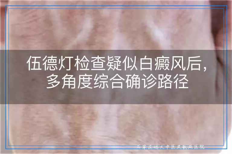 伍德灯检查疑似白癜风后，多角度综合确诊路径