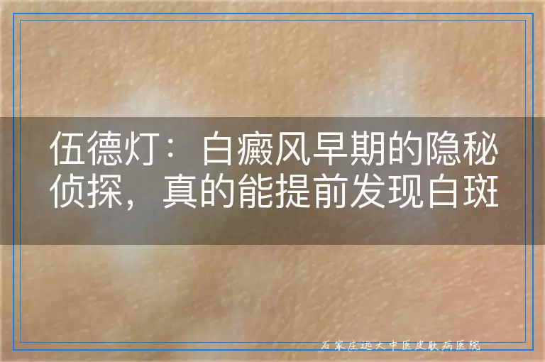 伍德灯：白癜风早期的隐秘侦探，真的能提前发现白斑吗？