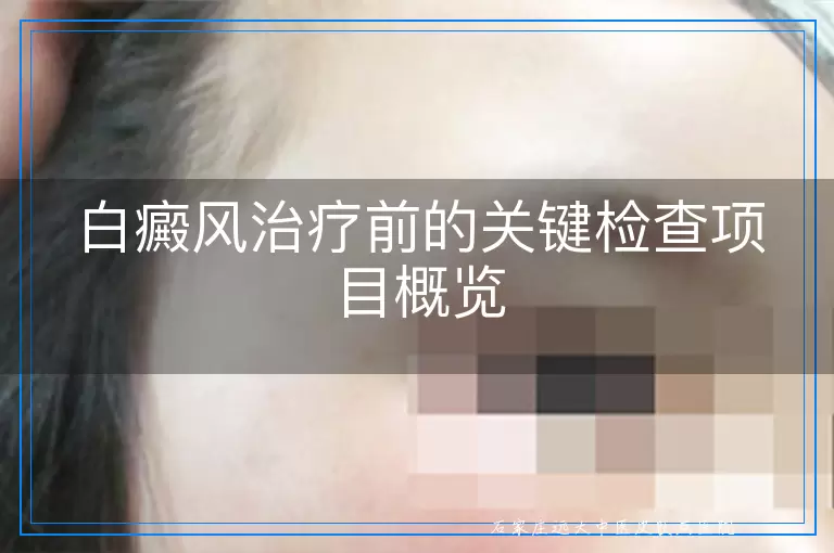 白癜风治疗前的关键检查项目概览