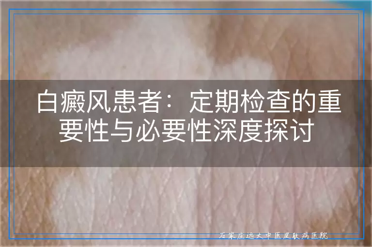 白癜风患者：定期检查的重要性与必要性深度探讨