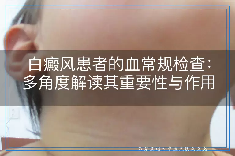 白癜风患者的血常规检查：多角度解读其重要性与作用