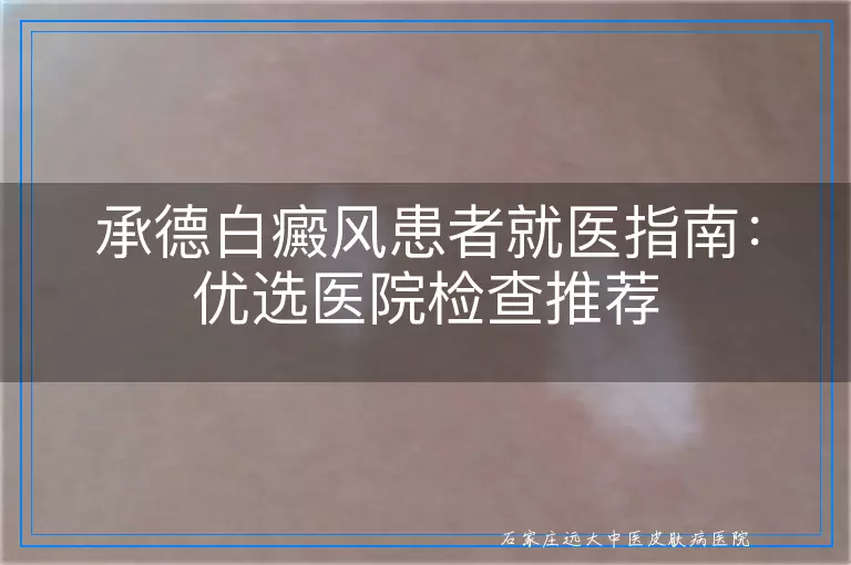 承德白癜风患者就医指南：优选医院检查推荐