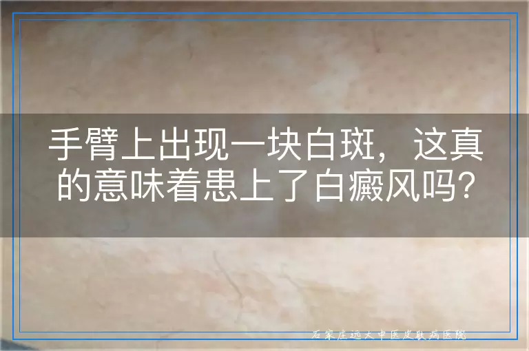 手臂上出现一块白斑，这真的意味着患上了白癜风吗？