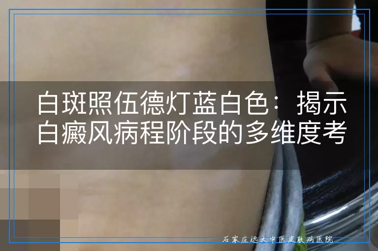 白斑照伍德灯蓝白色：揭示白癜风病程阶段的多维度考量