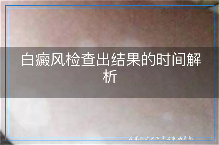 白癜风检查出结果的时间解析