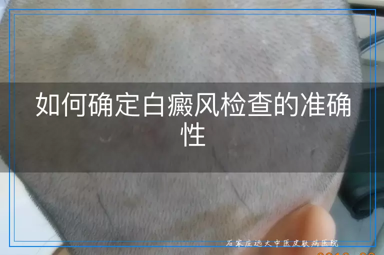 如何确定白癜风检查的准确性