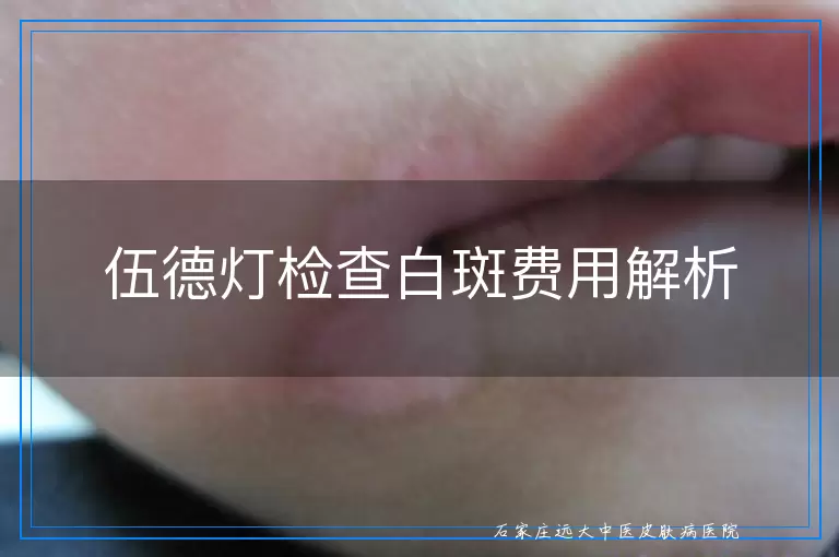 伍德灯检查白斑费用解析