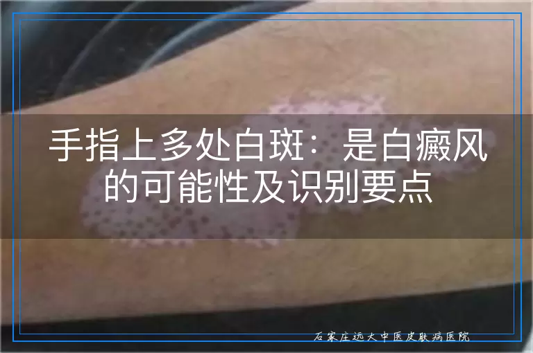 手指上多处白斑：是白癜风的可能性及识别要点