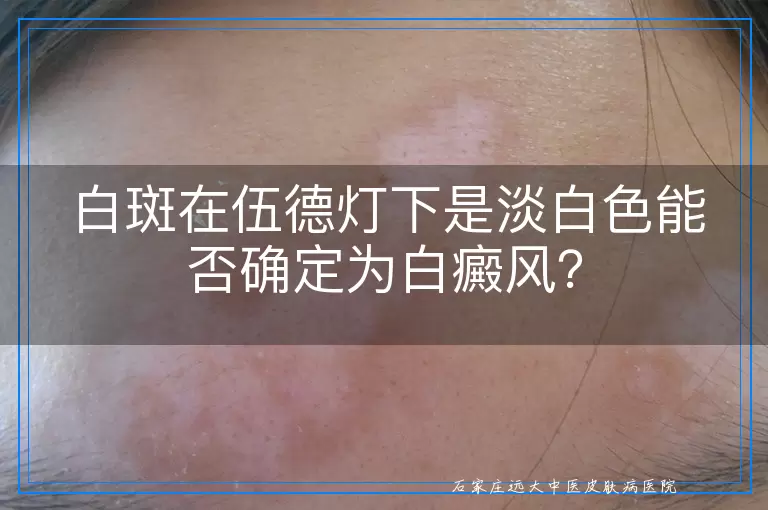 白斑在伍德灯下是淡白色能否确定为白癜风？