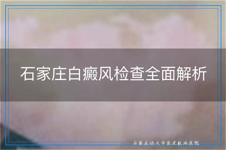 石家庄白癜风检查全面解析