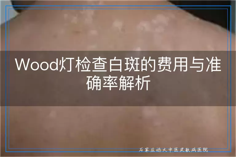 Wood灯检查白斑的费用与准确率解析