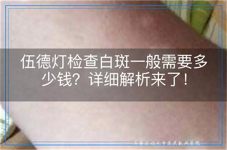 伍德灯检查白斑一般需要多少钱？详细解析来了！