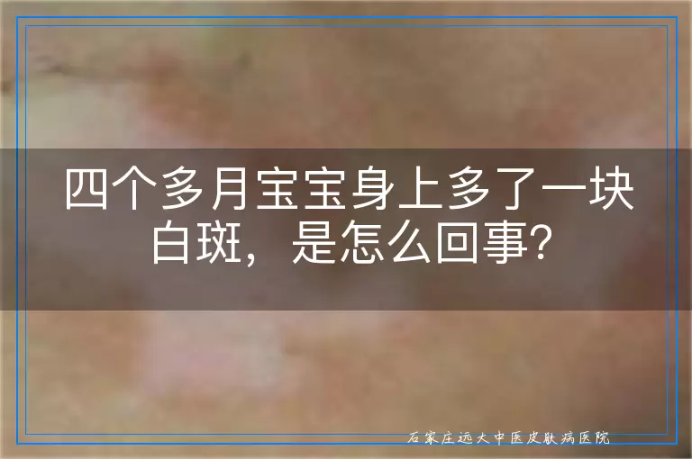 四个多月宝宝身上多了一块白斑，是怎么回事？