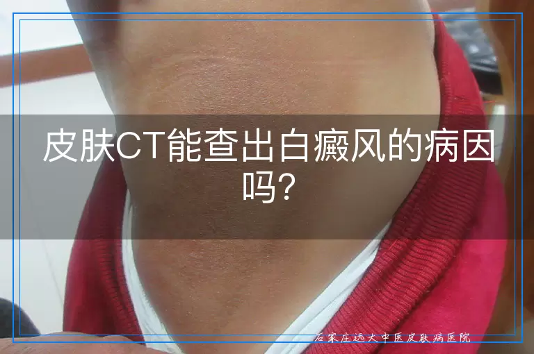 皮肤CT能查出白癜风的病因吗？