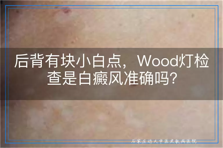 后背有块小白点，Wood灯检查是白癜风准确吗？
