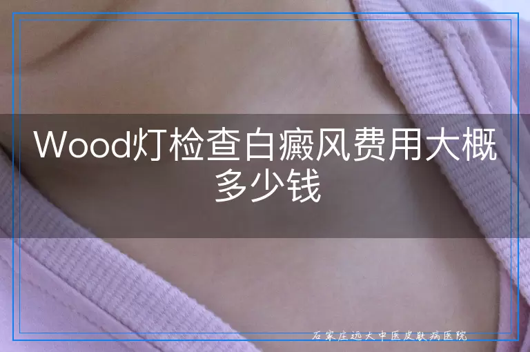 Wood灯检查白癜风费用大概多少钱