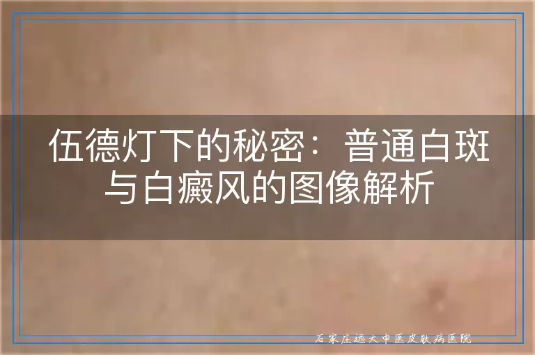 伍德灯下的秘密：普通白斑与白癜风的图像解析