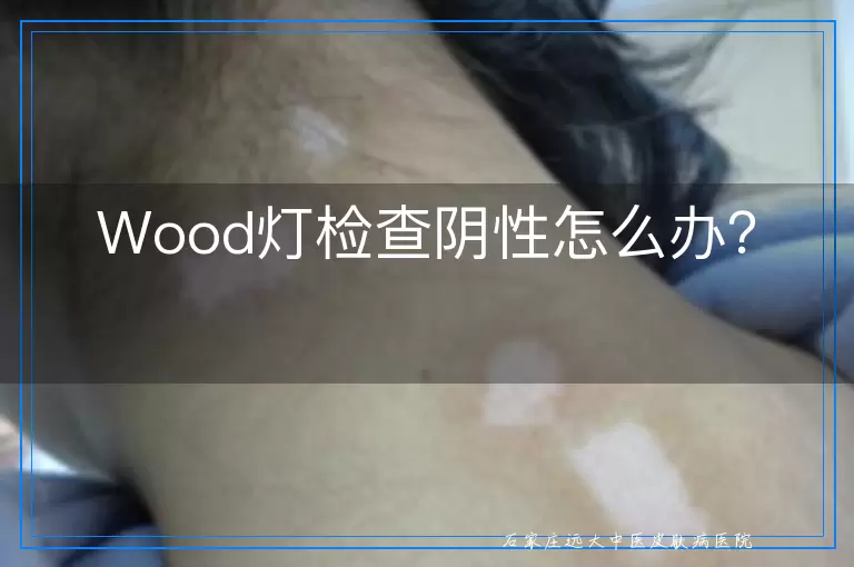Wood灯检查阴性怎么办？