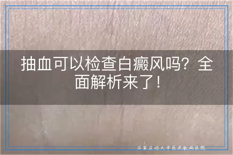 抽血可以检查白癜风吗？全面解析来了！