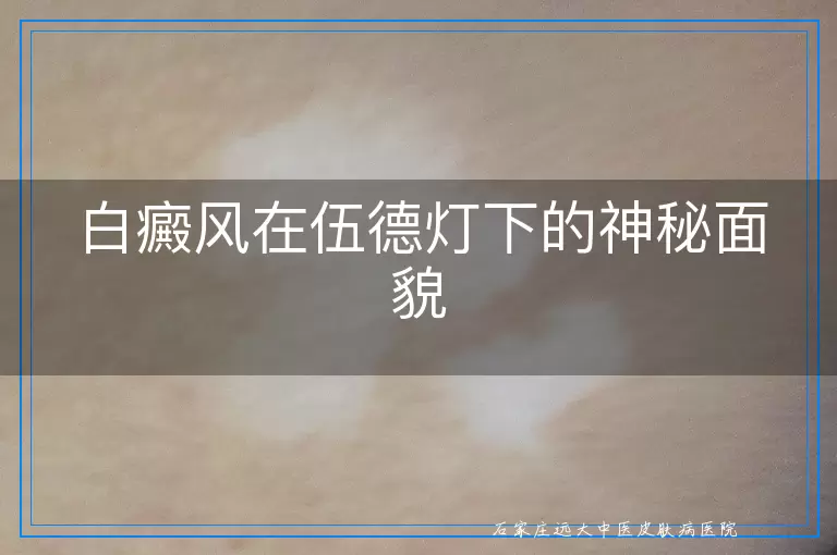 白癜风在伍德灯下的神秘面貌