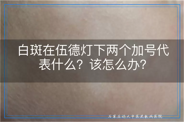 白斑在伍德灯下两个加号代表什么？该怎么办？